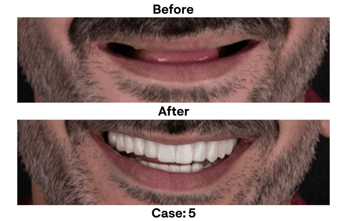 Bacase51.png